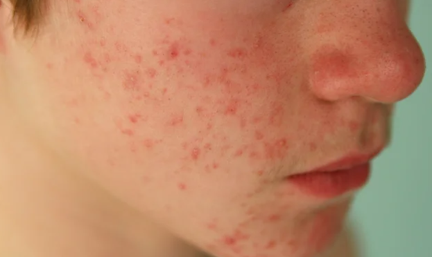 Can What You Eat Affect Acne and Scarring? A Closer Look at Diet and Skin Health